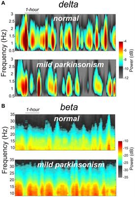 Slow-wave sleep dysfunction in mild parkinsonism is associated with excessive beta and reduced delta oscillations in motor cortex